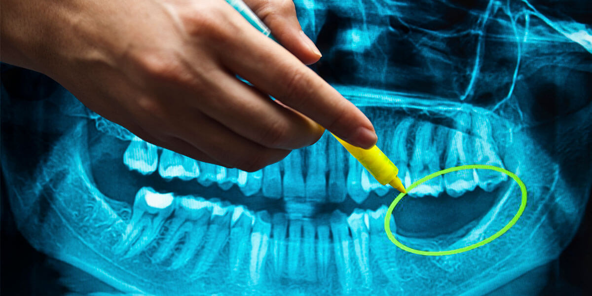 Benefits of Dental Implants in Midtown
